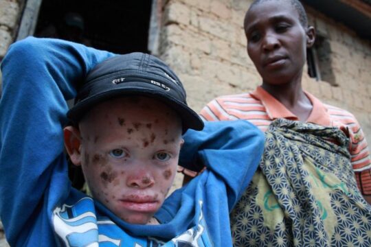 Malawi: Eltern ermorden ihr Albino-Kind, um Leichenteile zu verkaufen